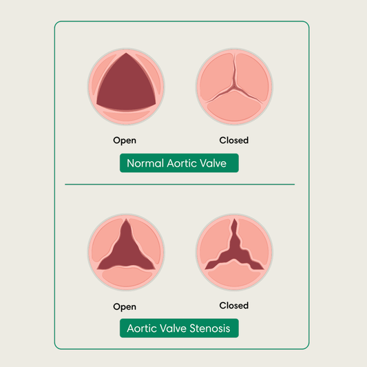 Aortic Stenosis