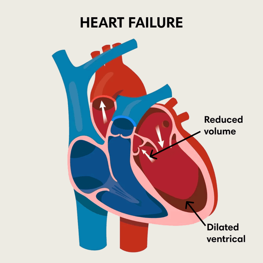 Illustration of heart failure using anatomical heart