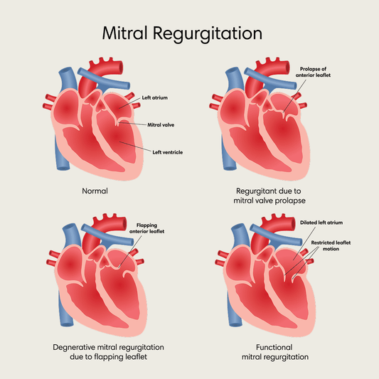 Mitral Regurgitation