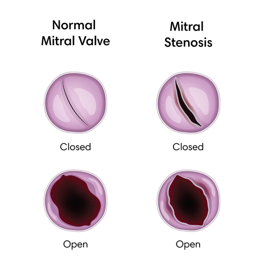 Mitral Stenosis