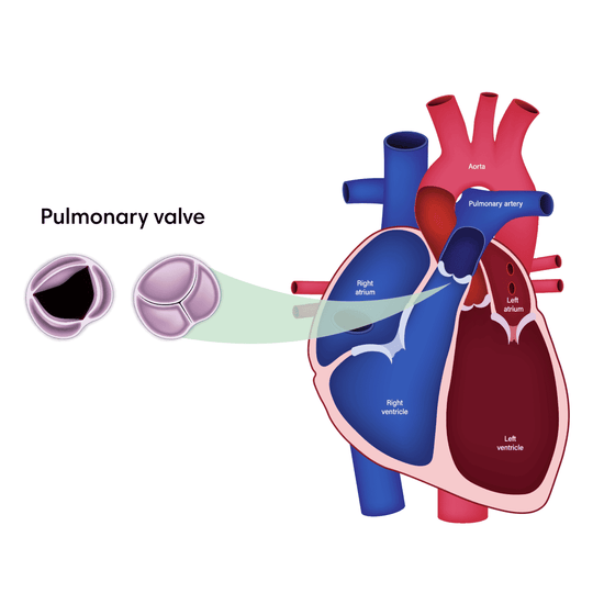 Pulmonary Valve Disease