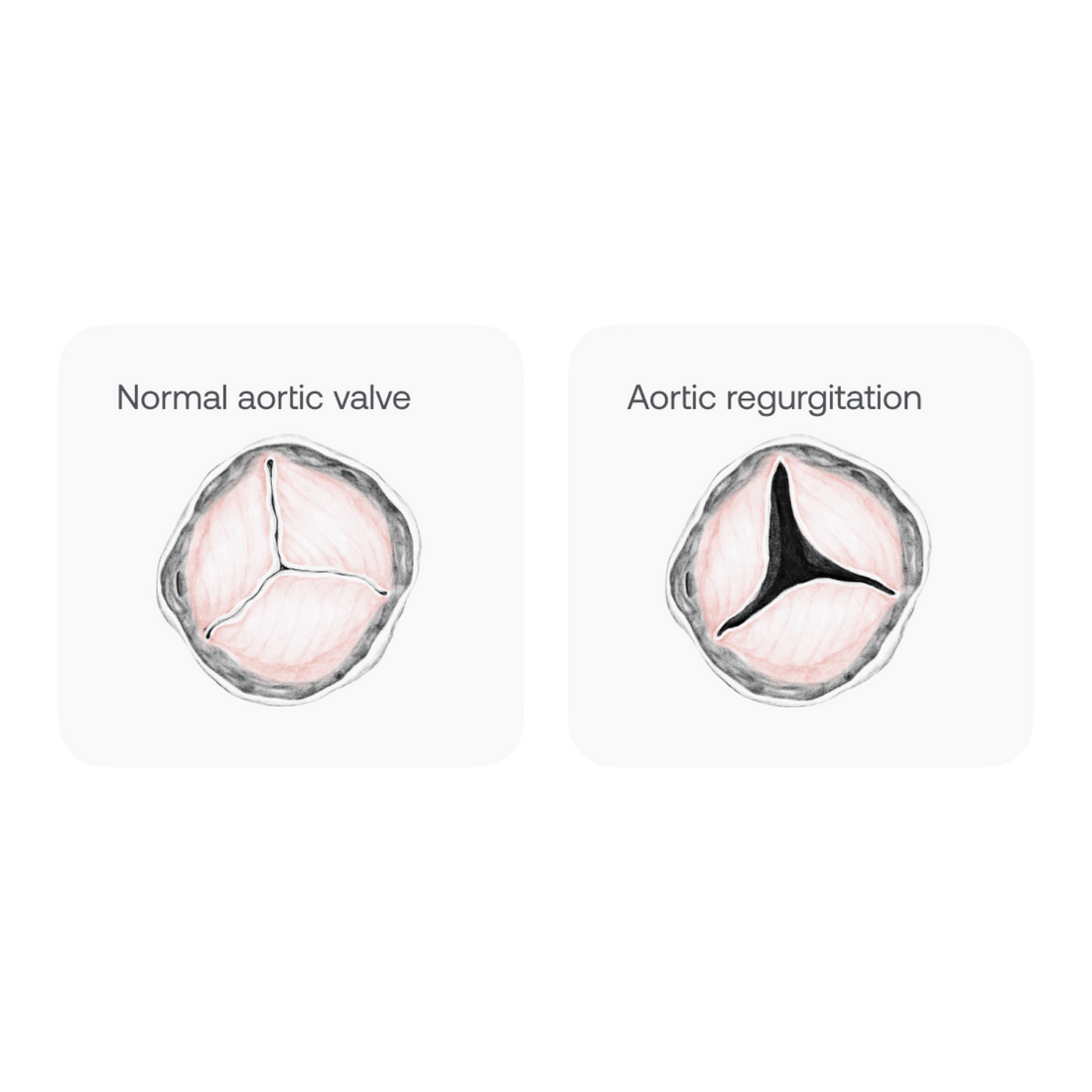 Aortic Regurgitation