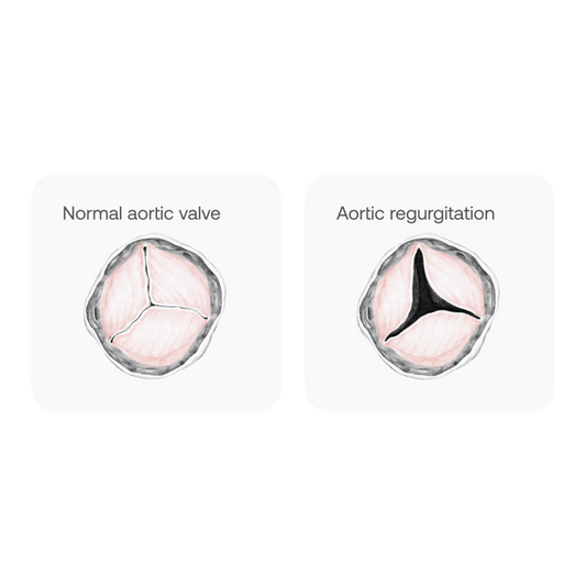 Aortic Regurgitation