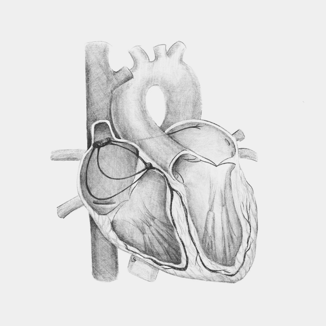 AFib Differential Diagnosis: Determining Other Causes