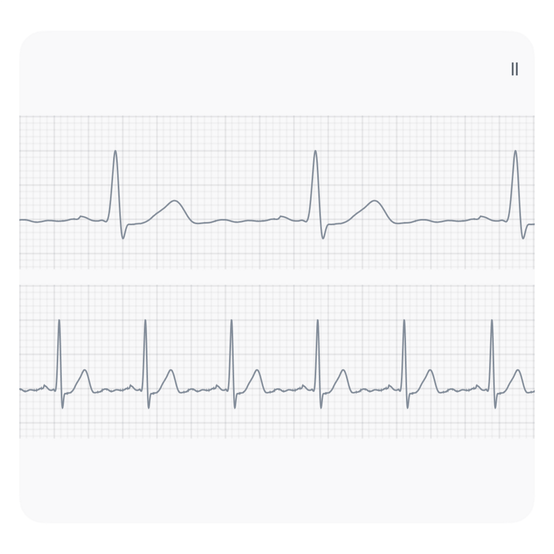 two ECG samples one above (Bradycardia) the other (Tachycardia) depicting arrhythmias