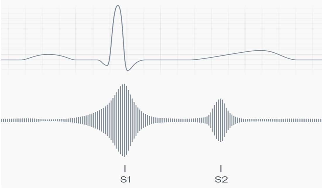 Why Phonocardiograms (PCG) Are Valuable