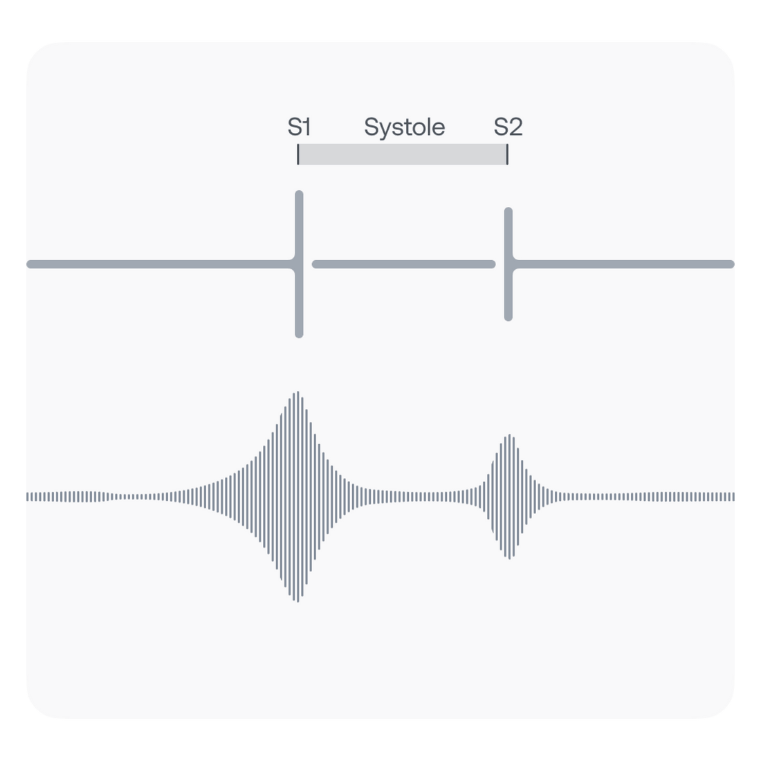 PCG and graphical representation of a systolic murmur