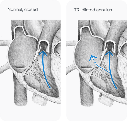 Pencil drawing of hearts with and without Tricuspid Regurgitation 