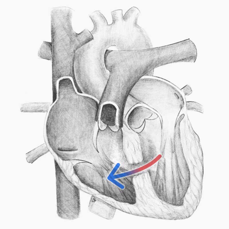 Pencil drawing of heart showing VSD